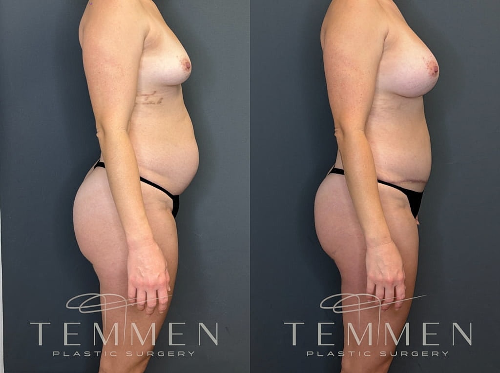 Mommy Makeover Before & After