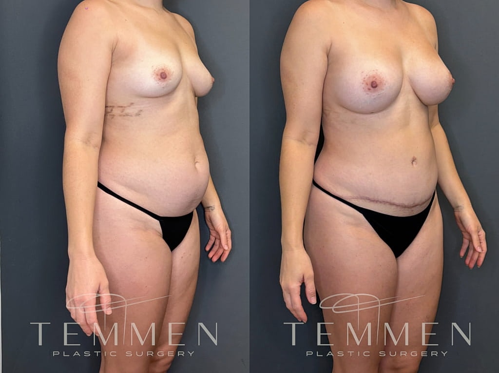 Mommy Makeover Before & After