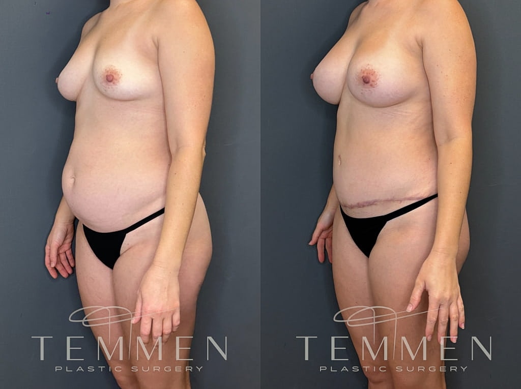 Mommy Makeover Before & After