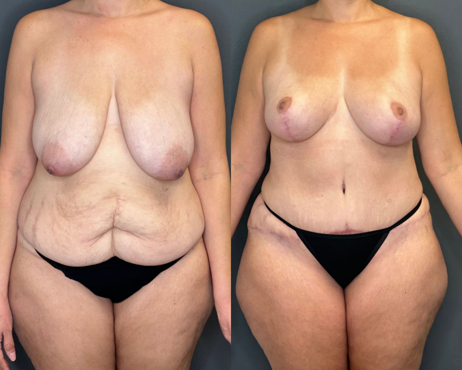 Mommy Makeover Before & After