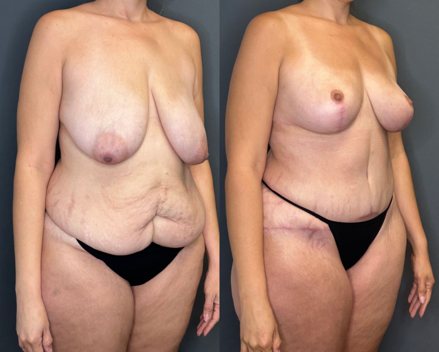 Mommy Makeover Before & After