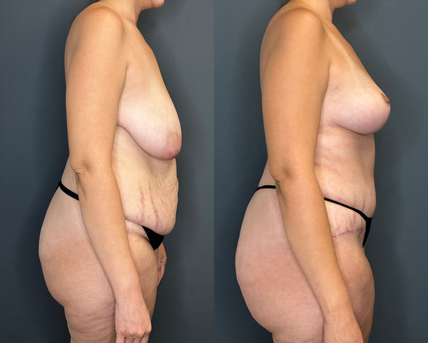 Mommy Makeover Before & After