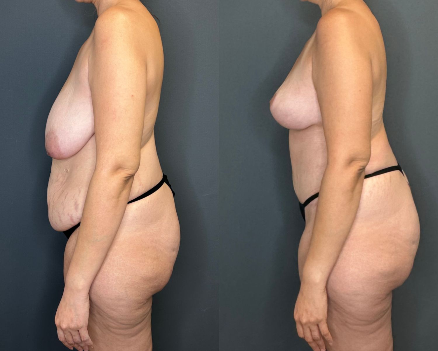 Mommy Makeover Before & After