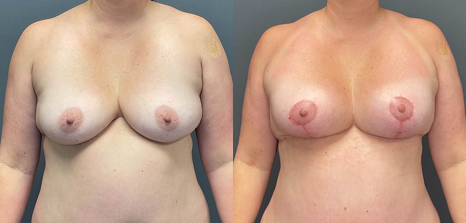 Breast Lift with Fat Transfer Before & After