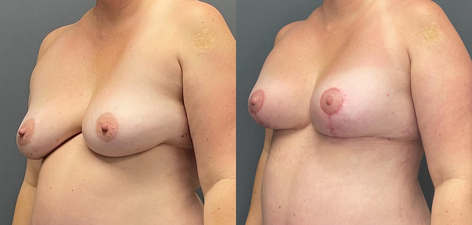 Breast Lift with Fat Transfer Before & After