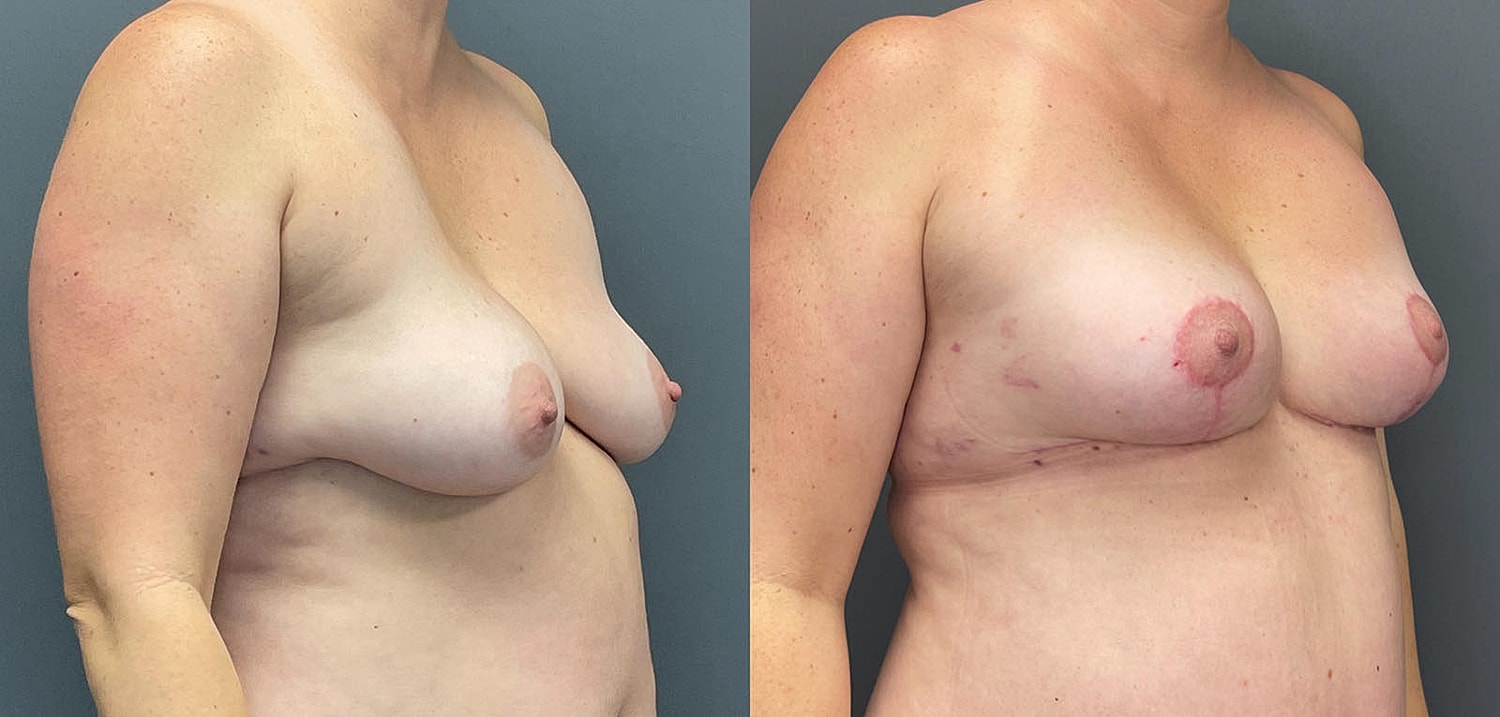 Breast Lift with Fat Transfer Before & After