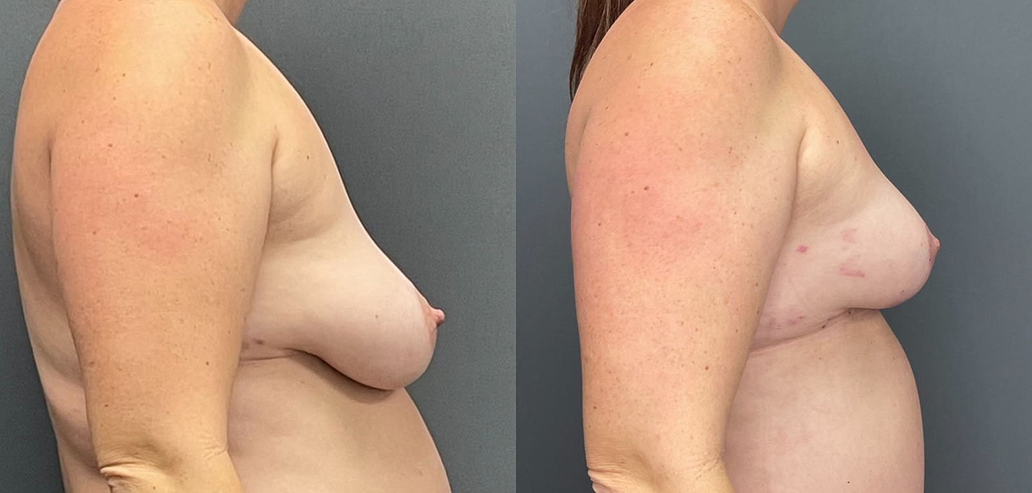 Breast Lift with Fat Transfer Before & After