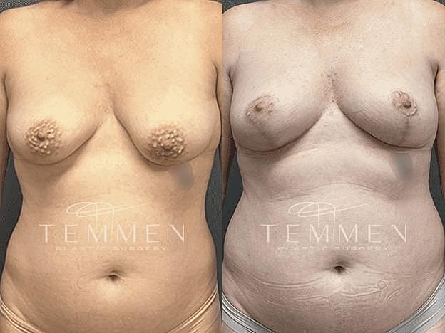 Breast Lift with Fat Transfer Before & After