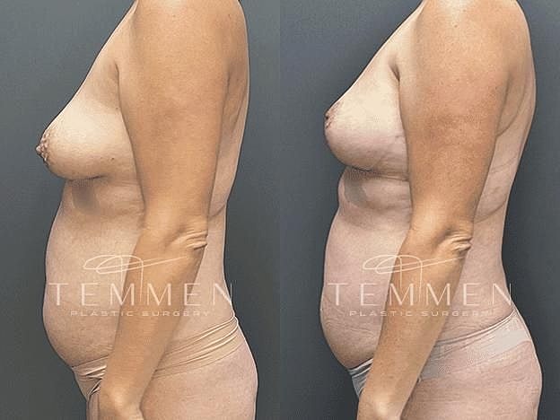 Breast Lift with Fat Transfer Before & After