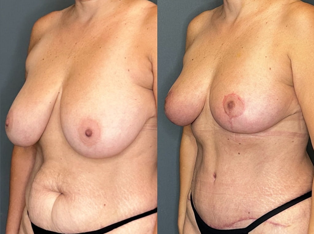 Breast Lift with Fat Transfer Before & After