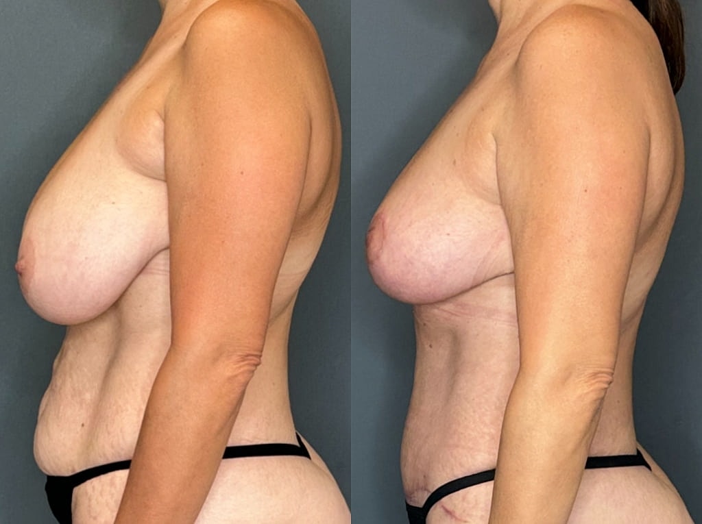 Breast Lift with Fat Transfer Before & After