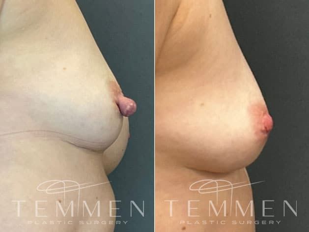 Nipple Reduction Before & After