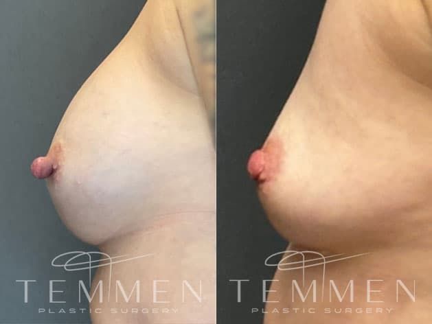 Nipple Reduction Before & After