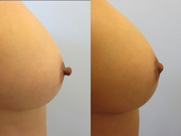 Nipple Reduction Before & After