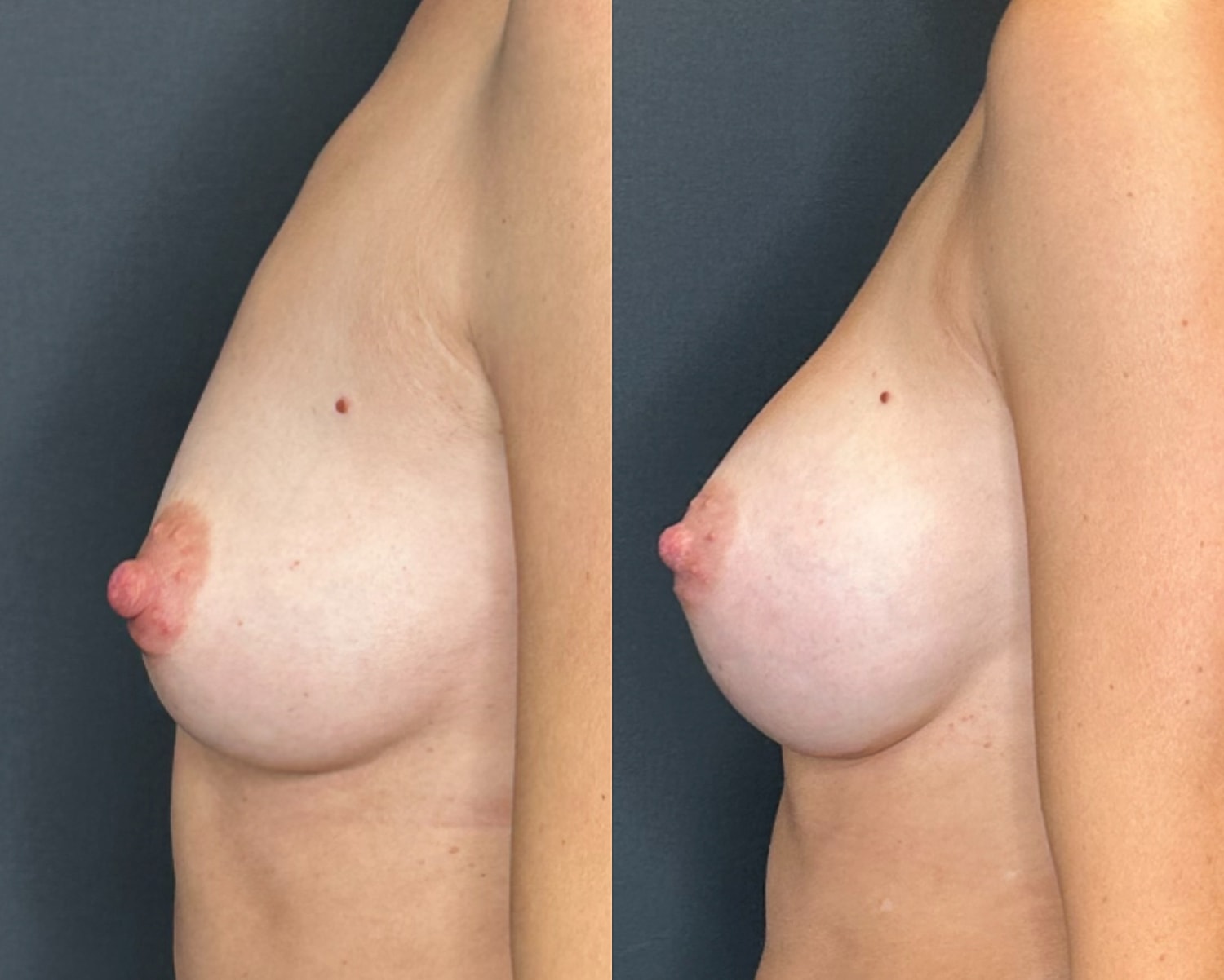 Nipple Reduction Before & After
