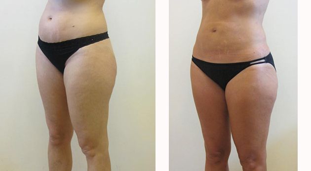 Liposuction Before & After