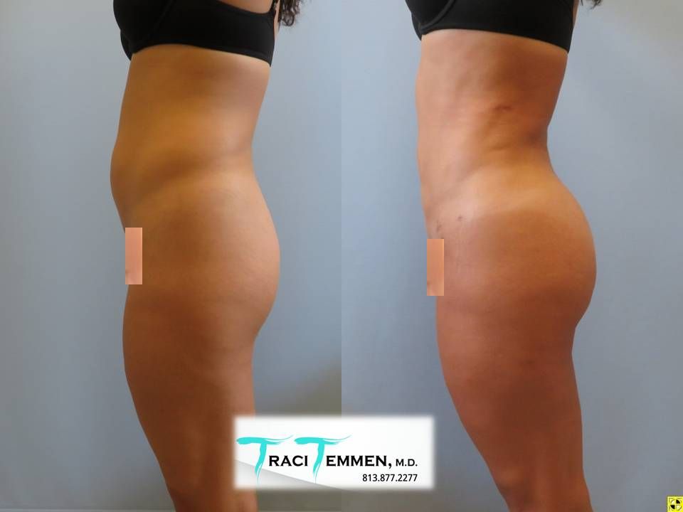 Liposuction Before & After