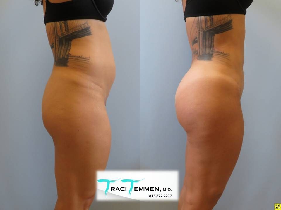 Liposuction Before & After
