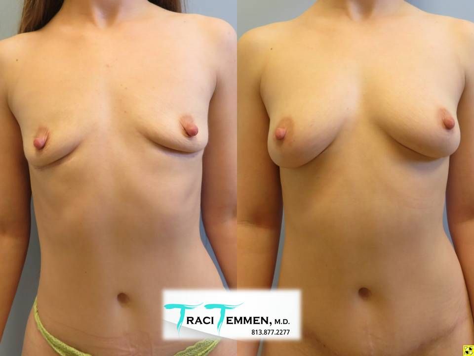 Liposuction Before & After