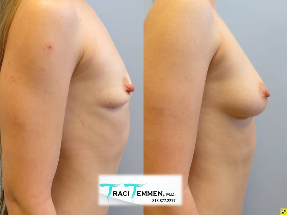 Liposuction Before & After