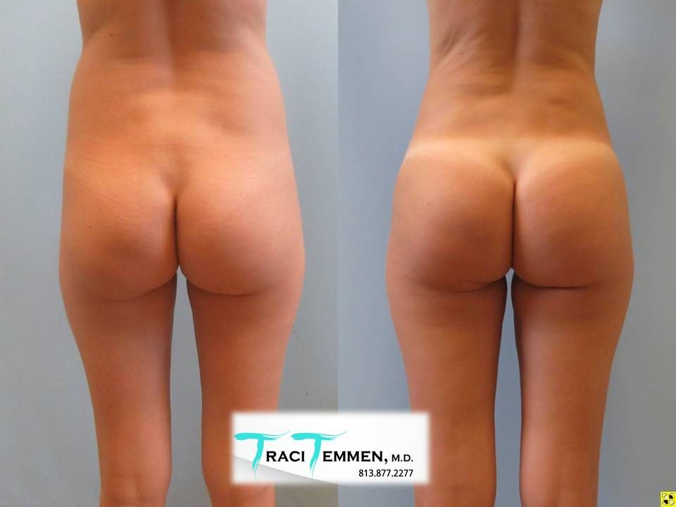 Liposuction Before & After