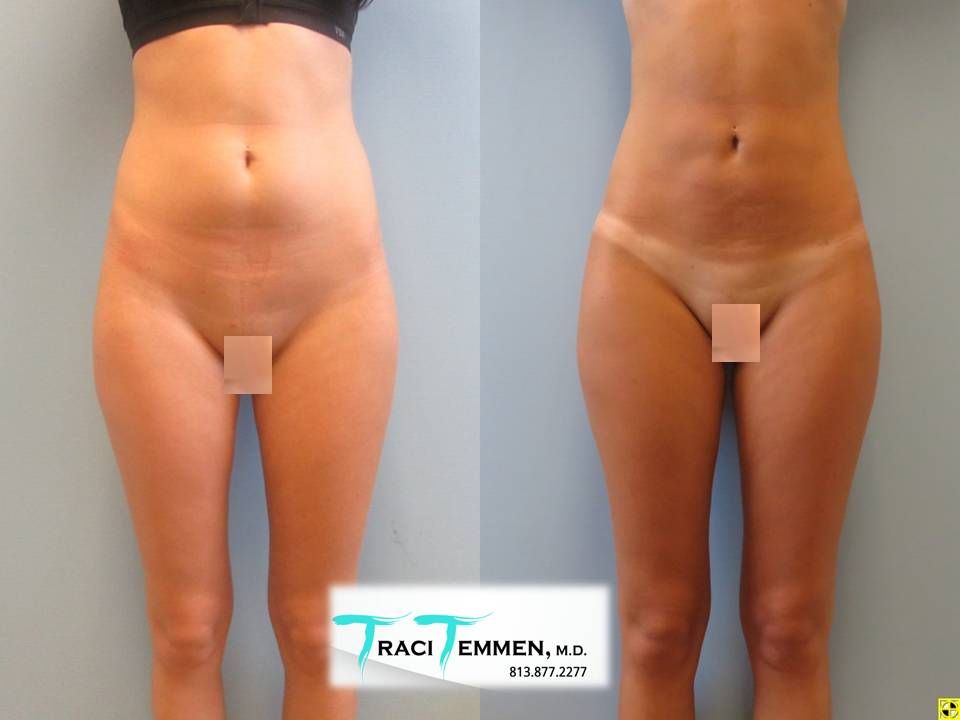 Liposuction Before & After
