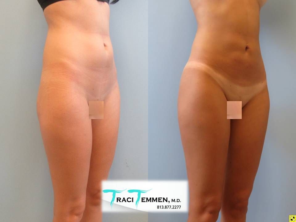 Liposuction Before & After