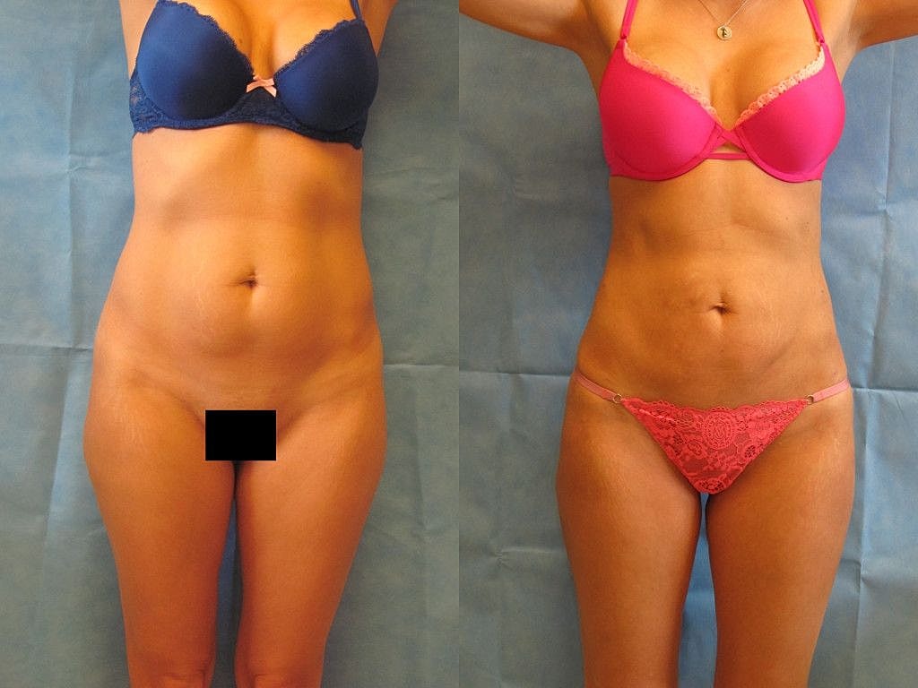 Liposuction Before & After