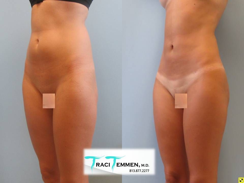 Liposuction Before & After