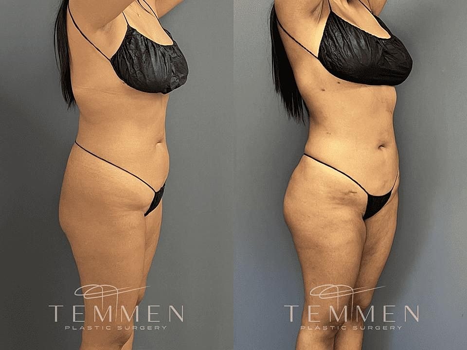 Liposuction Before & After