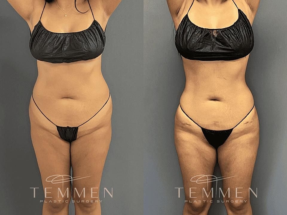 Liposuction Before & After