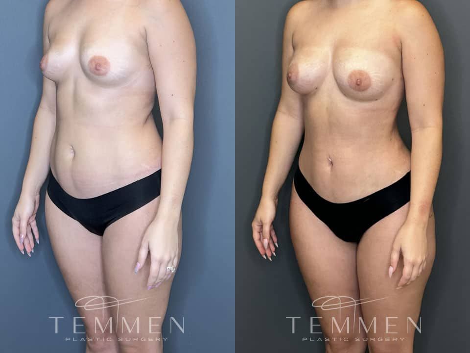 Liposuction Before & After