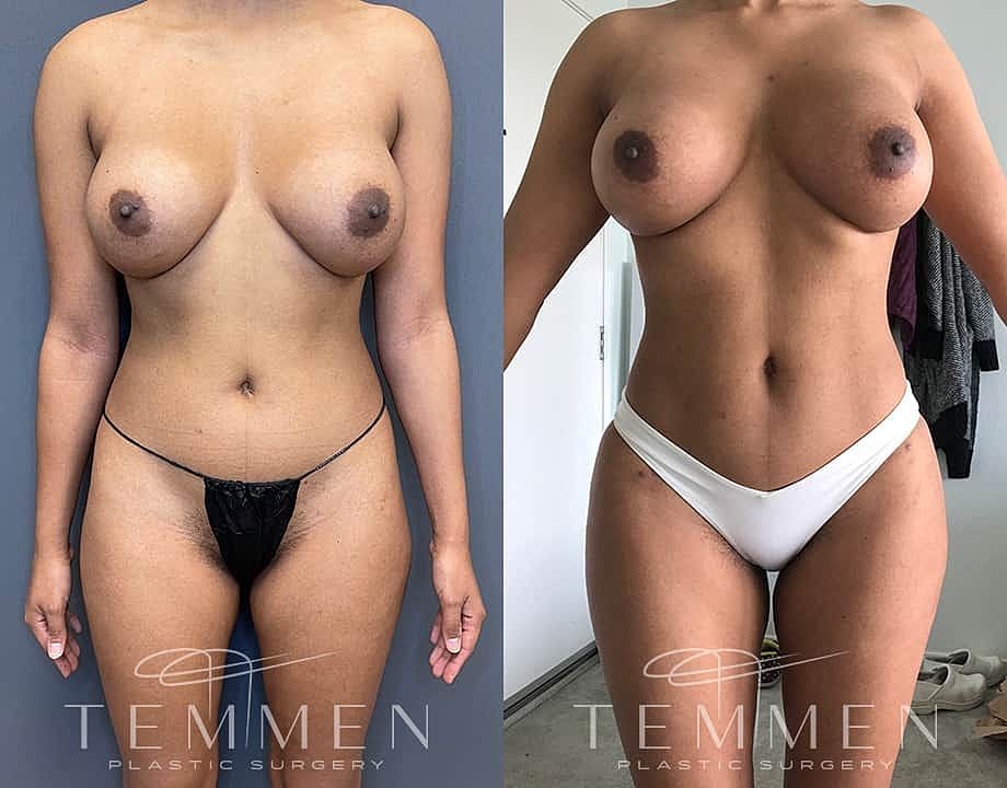 Liposuction Before & After