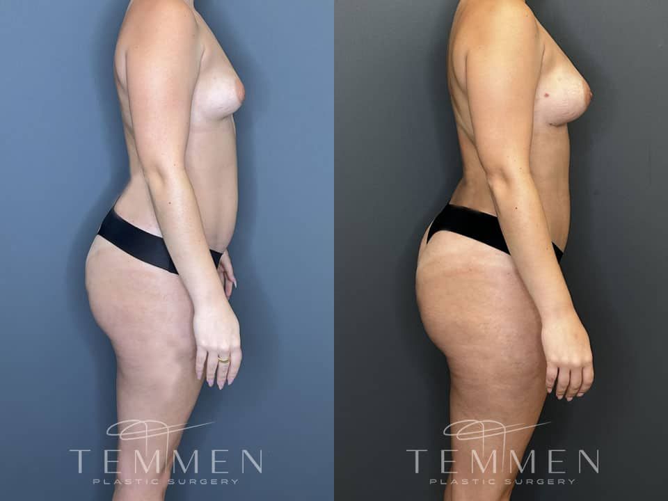 Liposuction Before & After