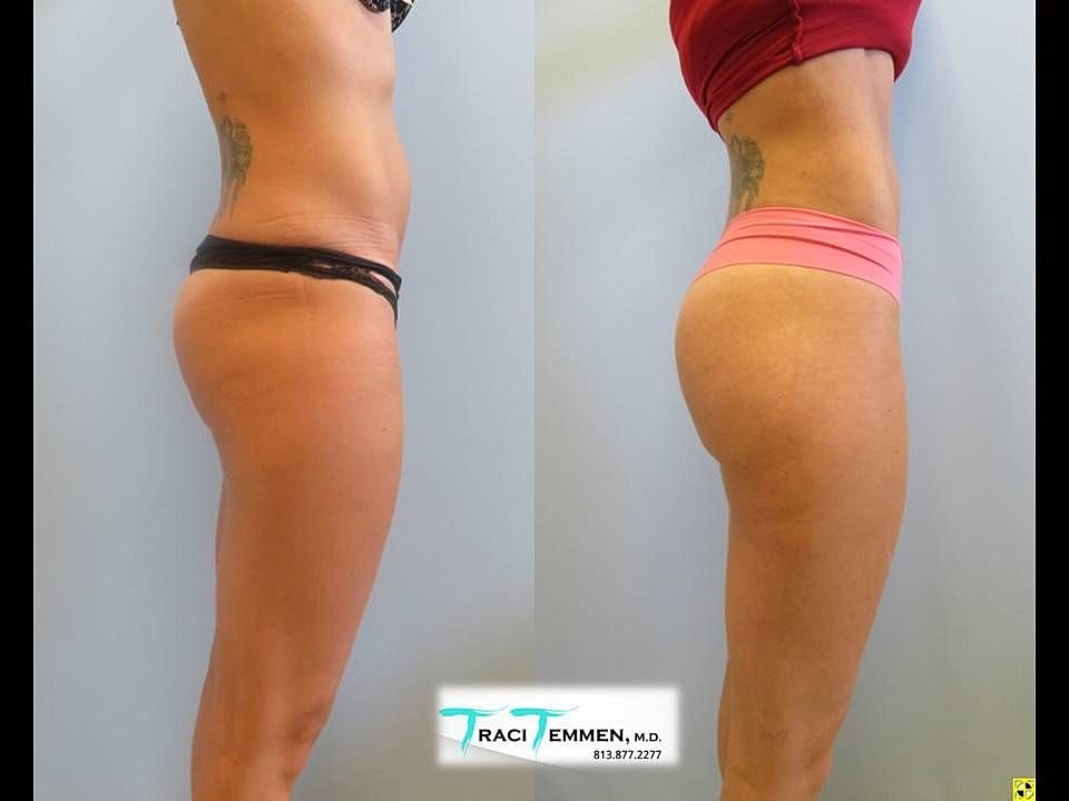 Liposuction Before & After