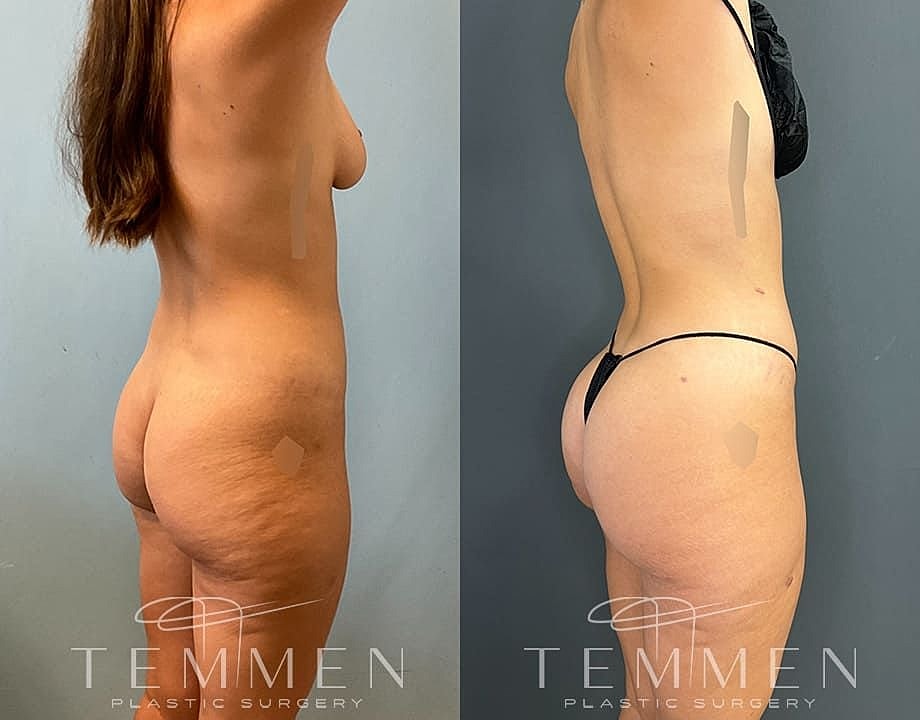 Liposuction Before & After