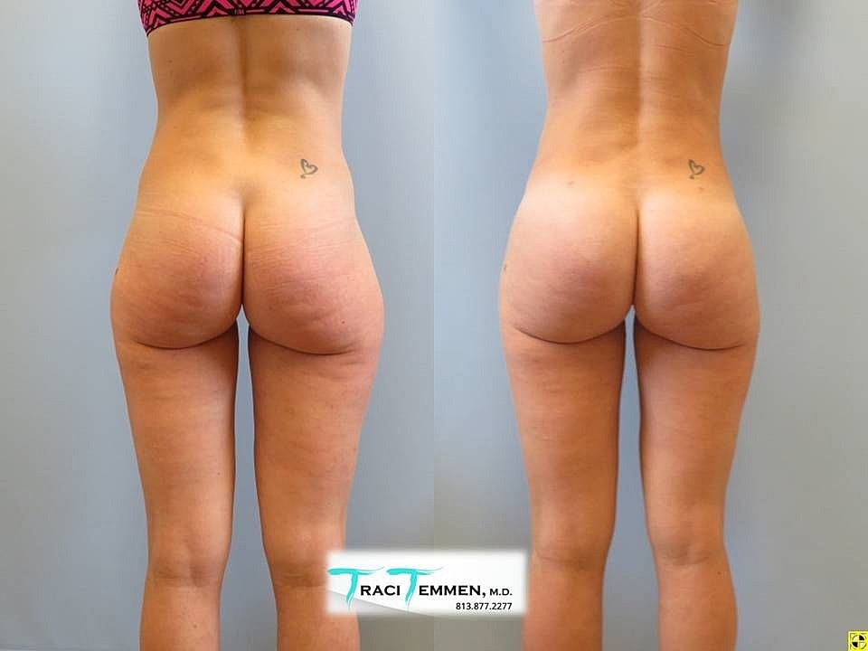 Liposuction Before & After