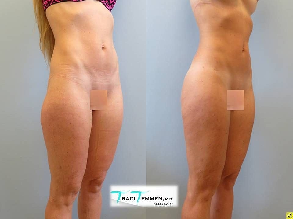 Liposuction Before & After