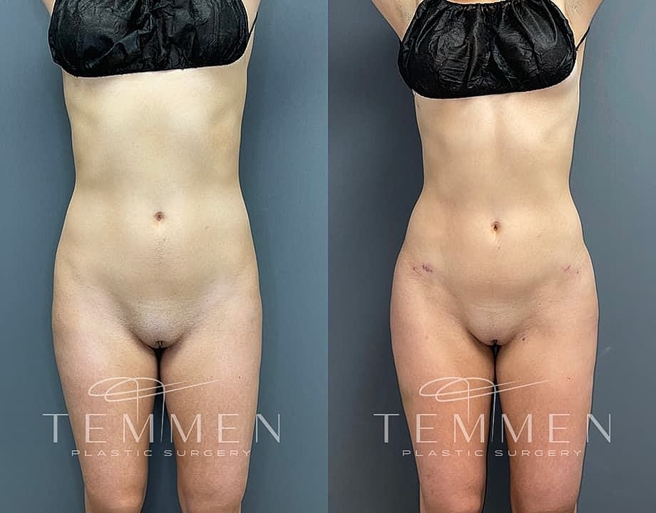 Liposuction Before & After