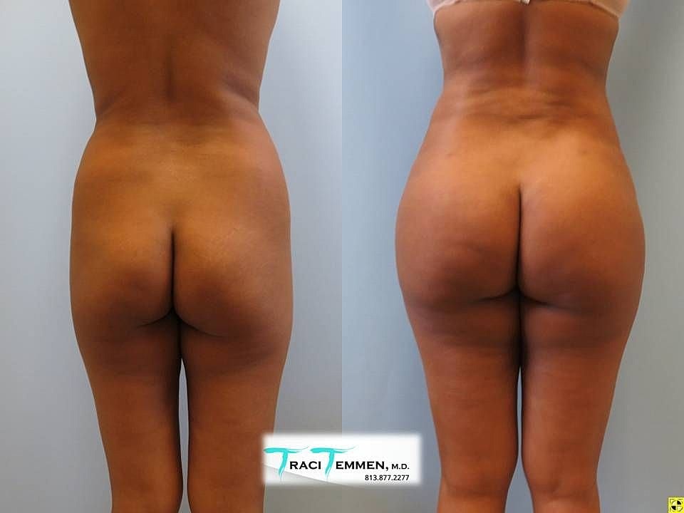 Liposuction Before & After