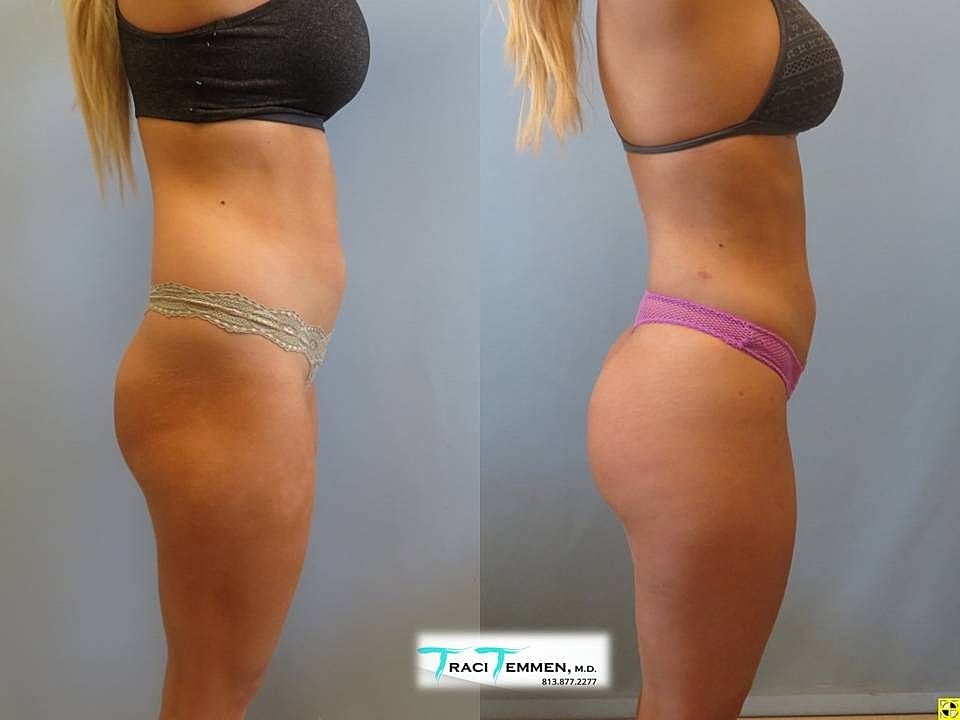 Liposuction Before & After