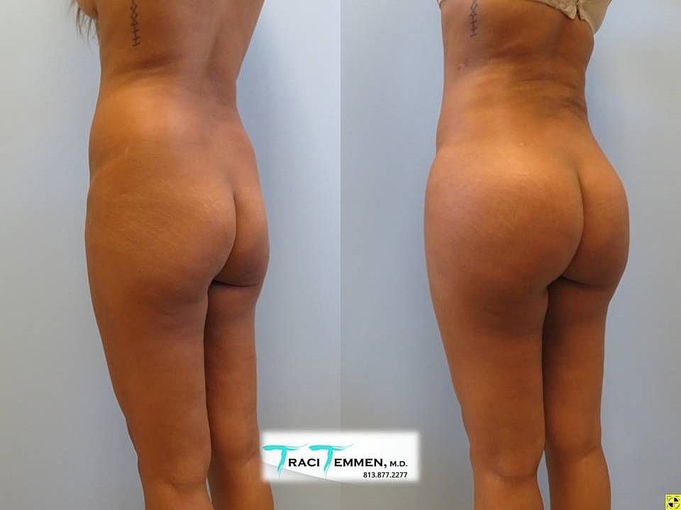 Liposuction Before & After
