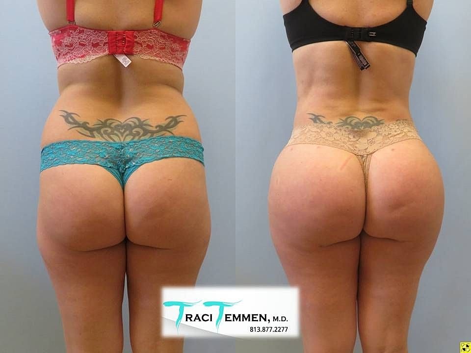 Liposuction Before & After