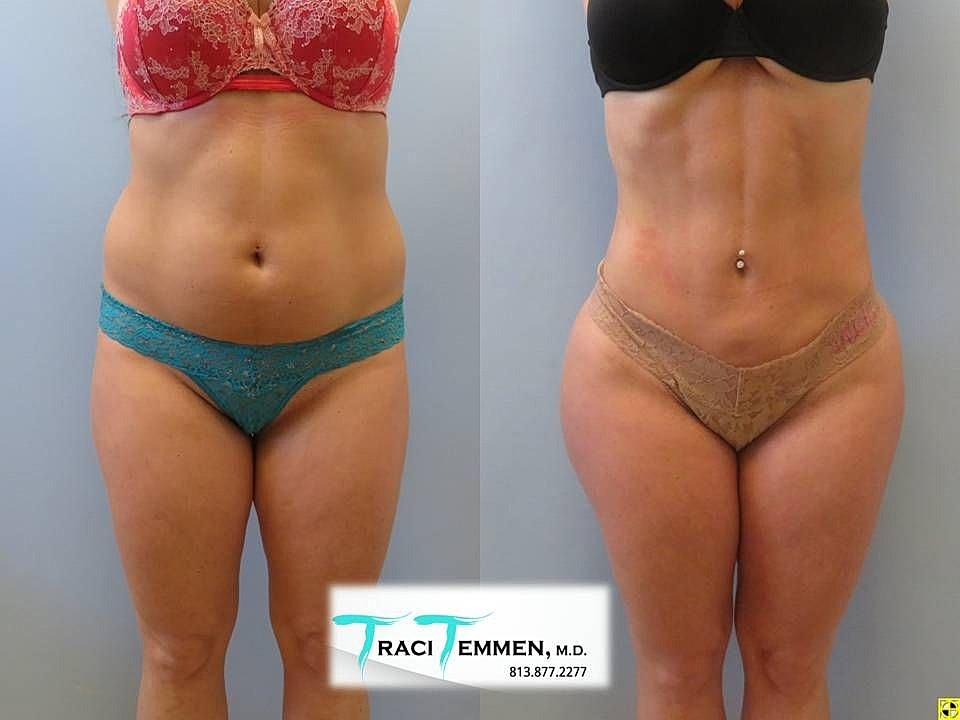 Liposuction Before & After