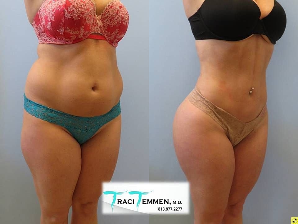 Liposuction Before & After