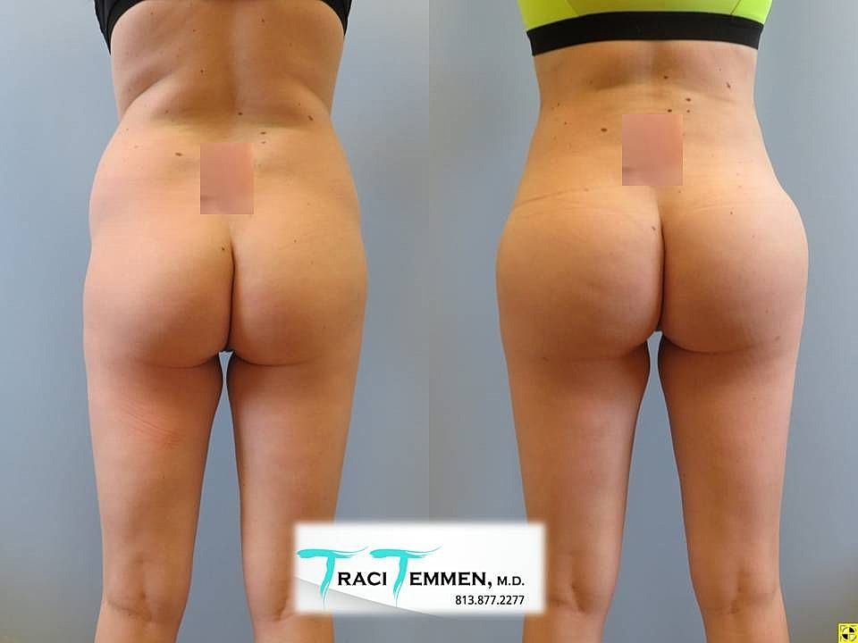 Liposuction Before & After