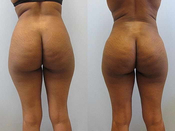 Liposuction Before & After
