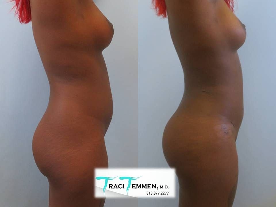 Liposuction Before & After