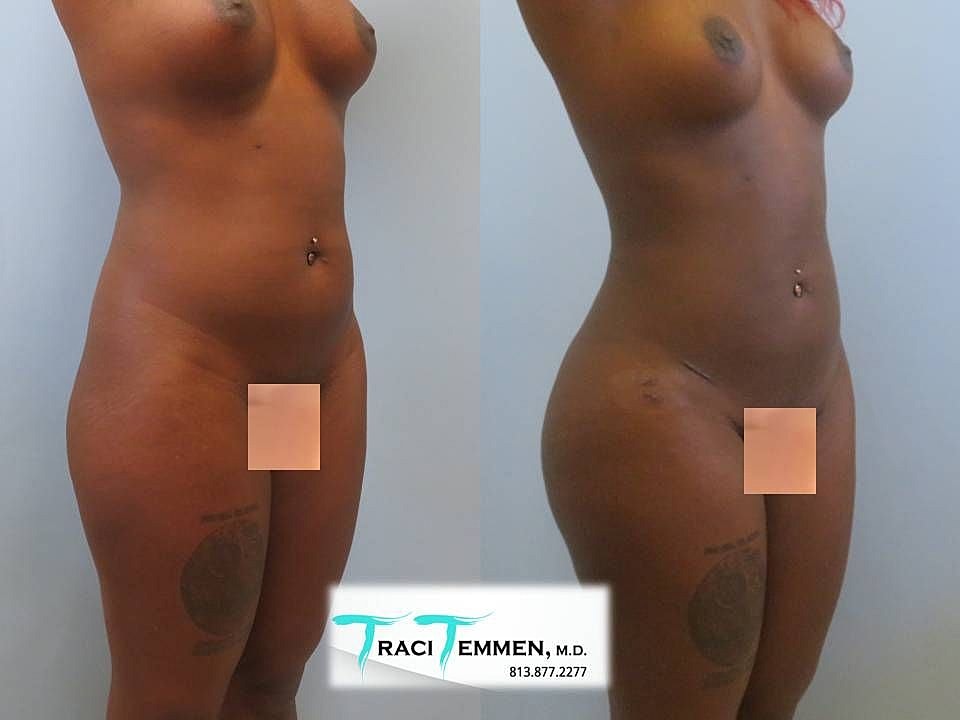 Liposuction Before & After