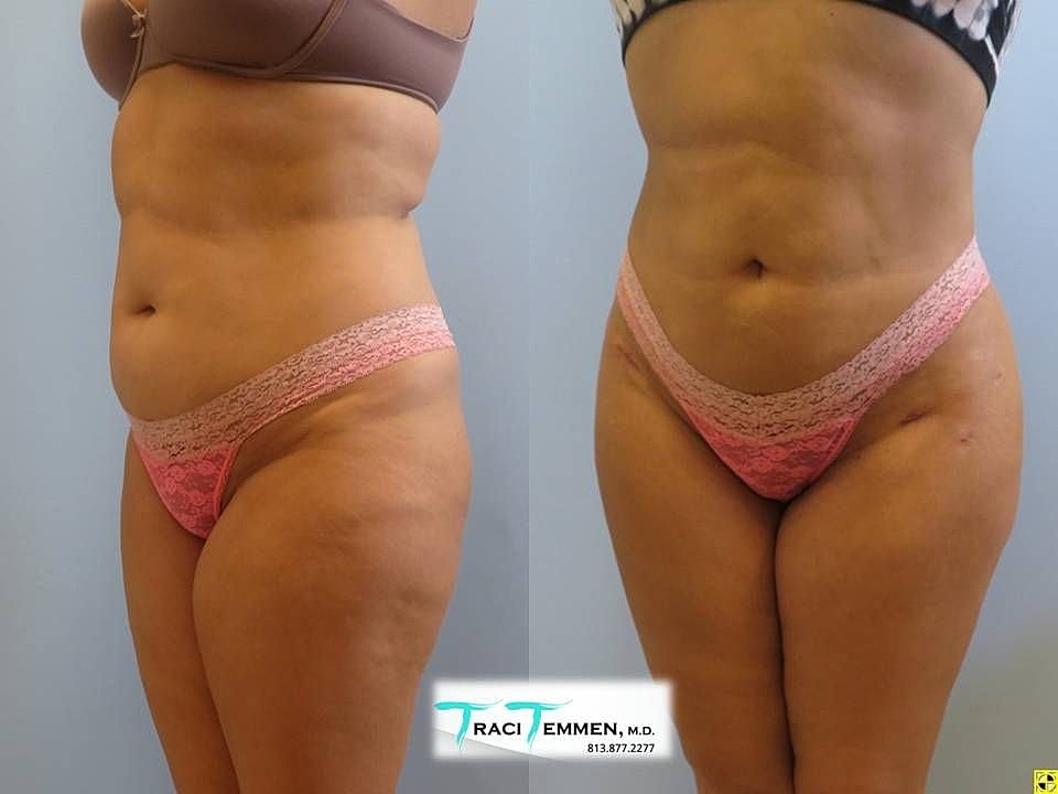 Liposuction Before & After